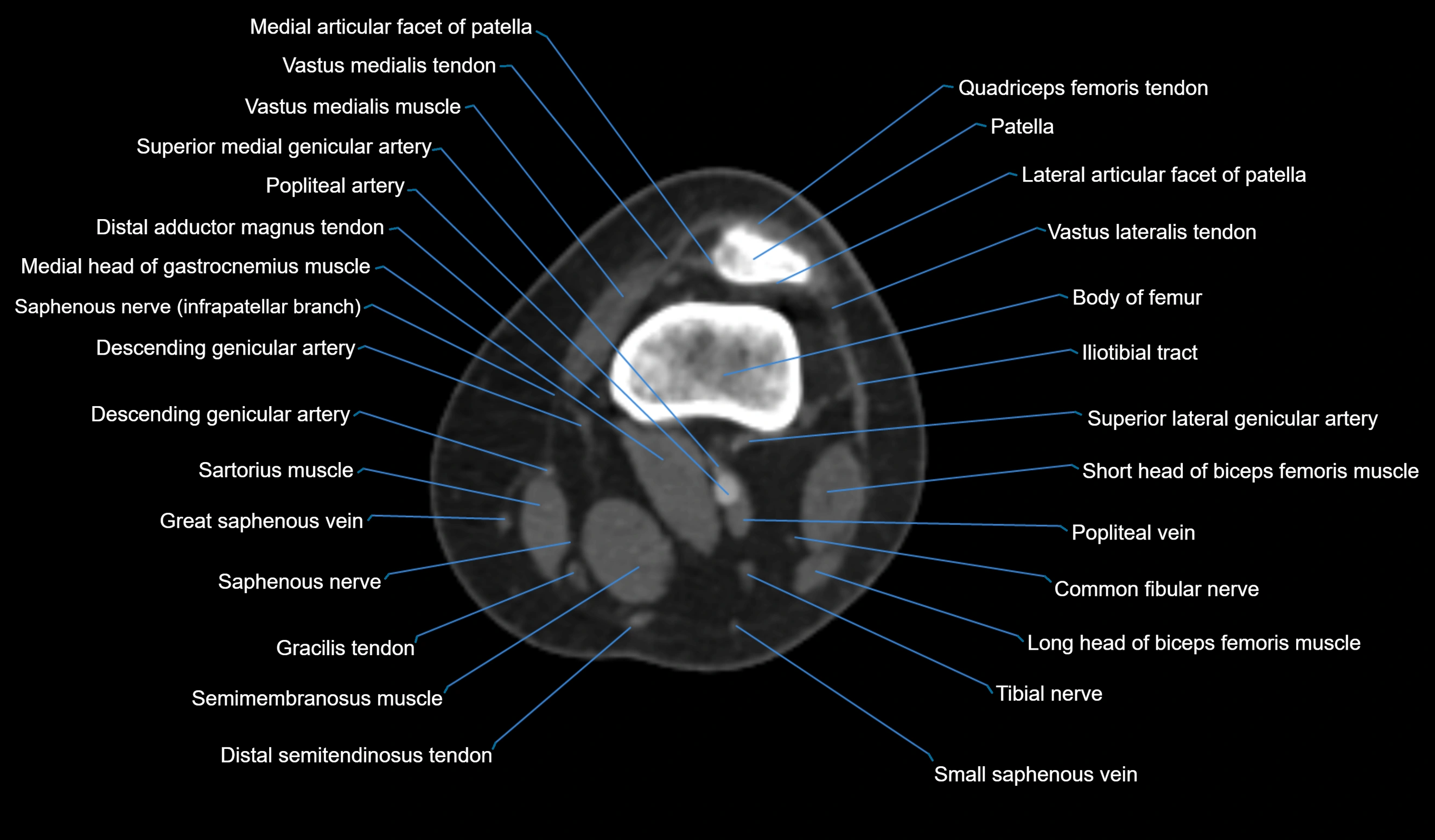 CT knee axial cross sectional anatomy labelled image-00019.webp